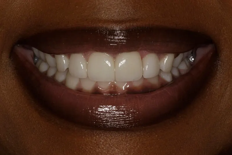 After: even, well-proportioned veneers across the smile.