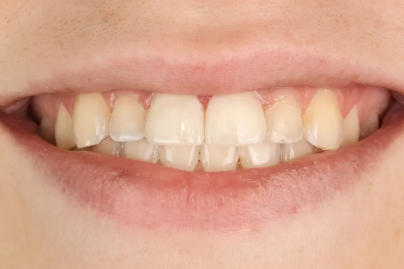 After: even, bright porcelain veneers across the upper front teeth.
