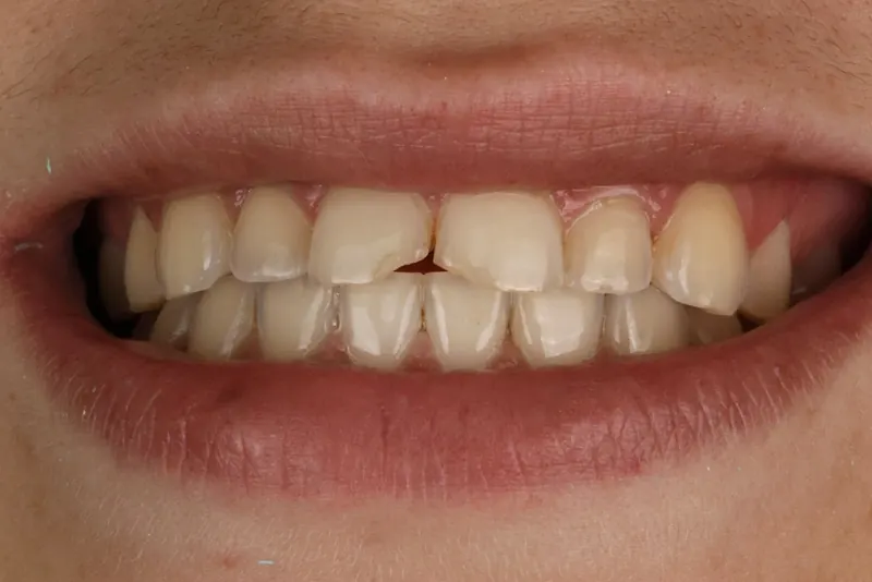 Before: uneven, yellowed upper front teeth with small gaps between them.